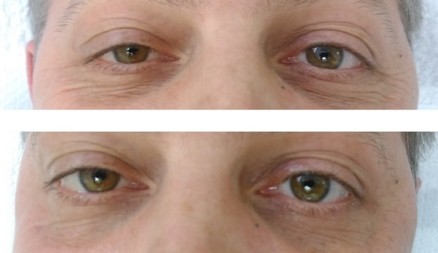 caudalie anti aging szérum szem és ajkak floslek anti aging pod oczy